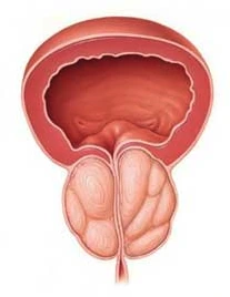 Illustration d’une prostate augmentée de volume